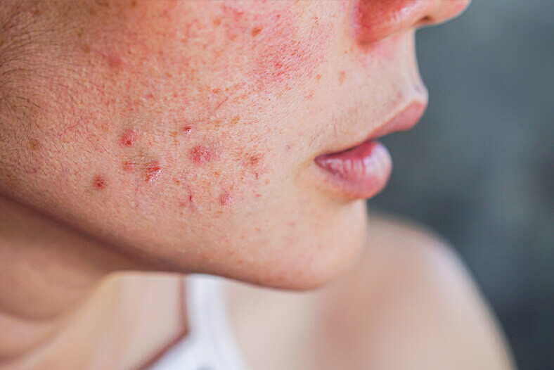 woman with severe acne on her face