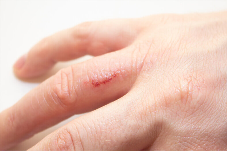 Contact Dermatitis on finger