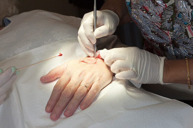 removing skin cancer from hand