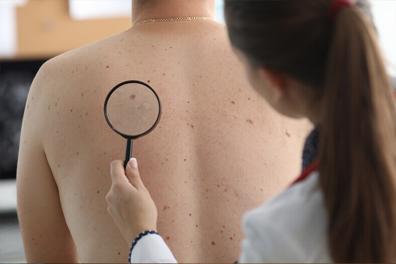 skin cancer specialist checking man's back for skin cancer