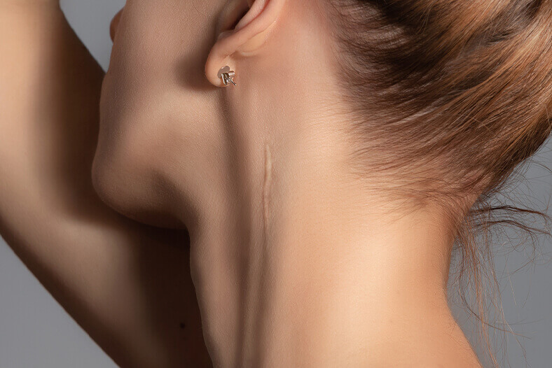 woman with a scar on her neck