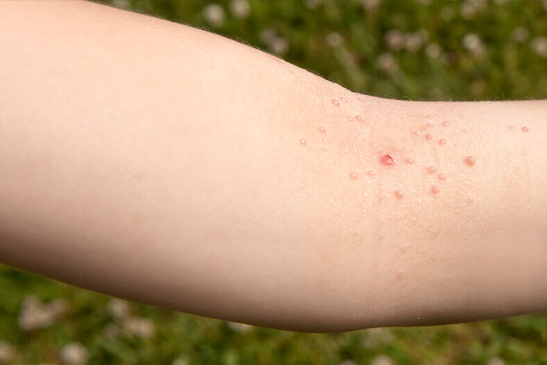 arm showing warts