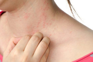 Woman with a neck rash