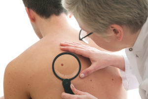 Doctor examining a patient's back mole
