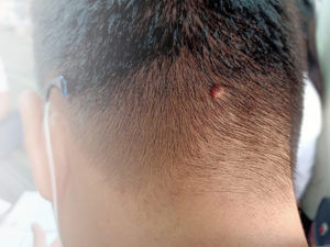 A mole on the back of a man's head who is about to undergone mohs surgery.