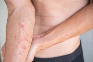 Stasis Dermatitis treatment for skin rashes