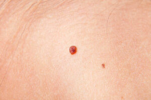 Skin cancer