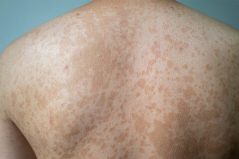 Tinea Versicolor Treatment in Georgia | Symptoms, Causes & Care