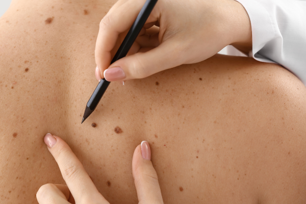 When Should You See a Dermatologist for a Skin Check in Georgia?