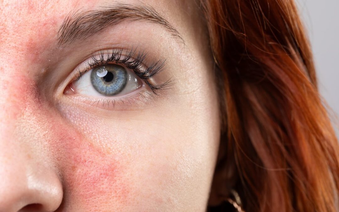 Laser for Rosacea: Treating Chronic Redness vs. Temporary Flushing