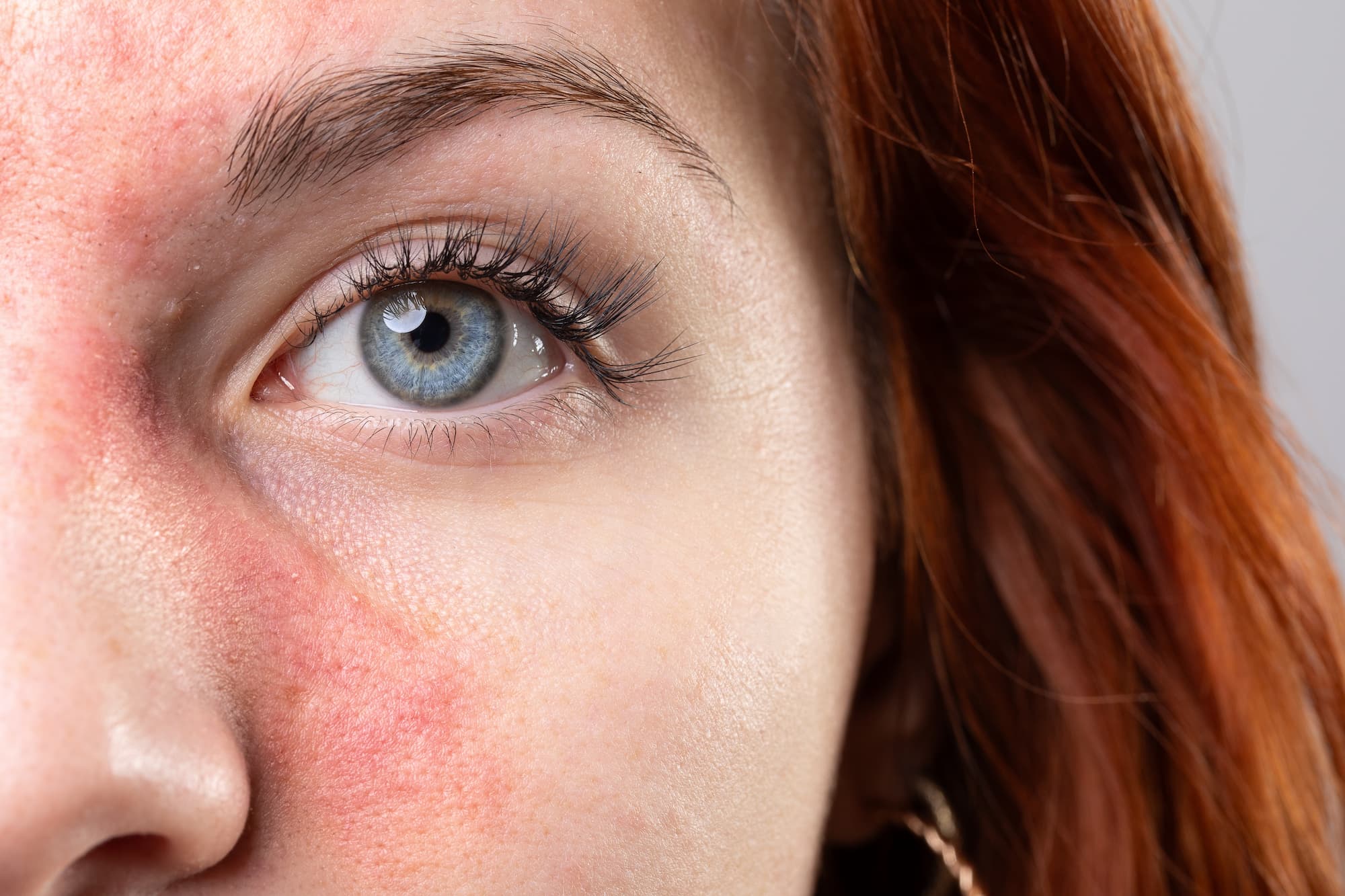 a closeup shot of a woman face with redness on her cheeks and nose from roasacea