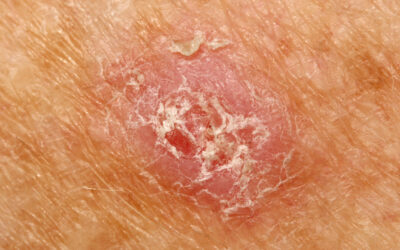 Actinic Keratosis (AK) Explained: When a “Rough Patch” is Actually Pre-Cancer