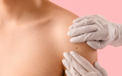 Please Don’t Freeze That Mole: The Dangers of DIY Skin Tag Removal