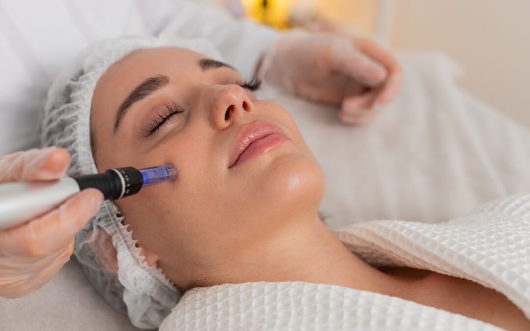 Microneedling Magic: Is It Worth the Price for Acne Scars?